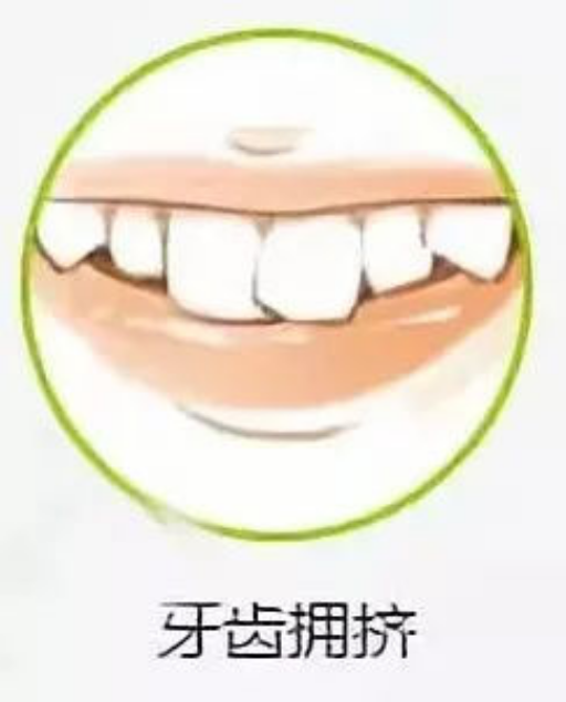 吸附性假牙跟强吸附性假牙的区别,这些事需注意
